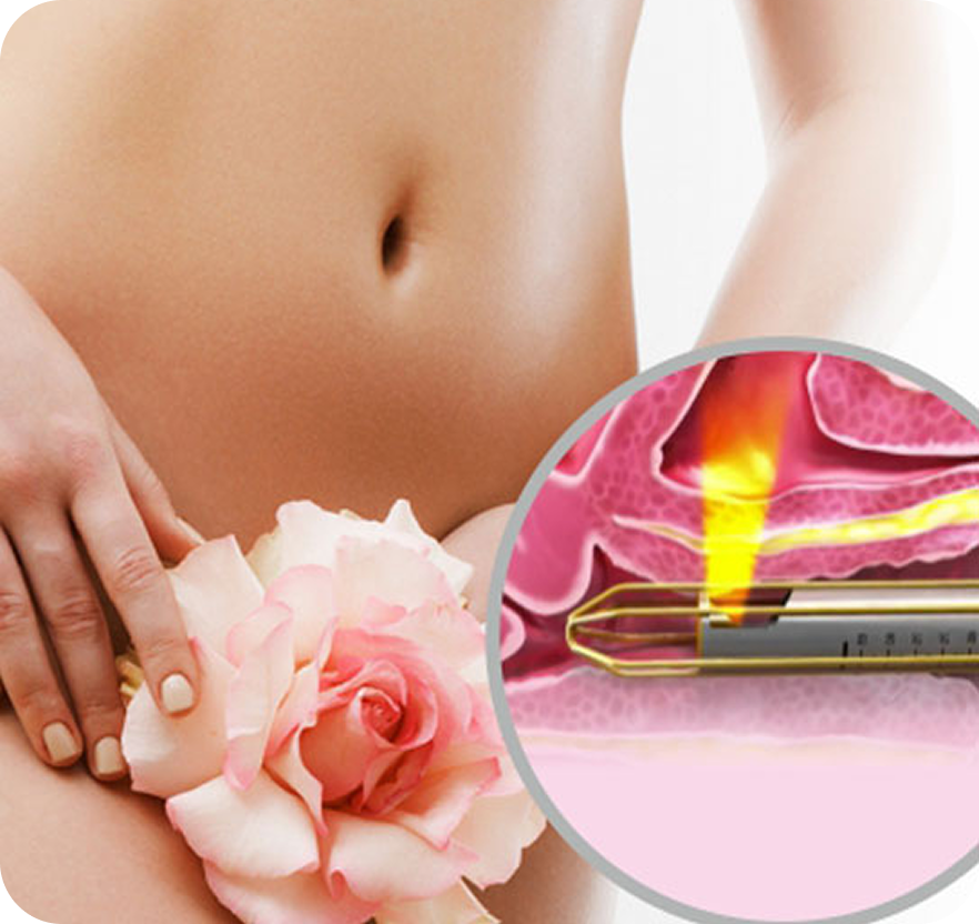 Cosmetic Gynecology Laser
